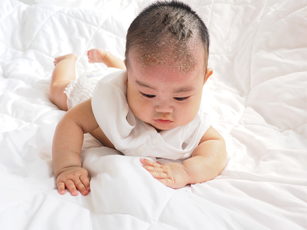An Asian baby with cradle cap, also known as seborrheic dermatitis, trying to crawl on the bed.