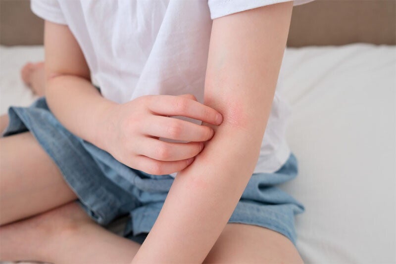 Asian preschool-age girl with eczema or atopic dermatitis scratches inside of her elbow