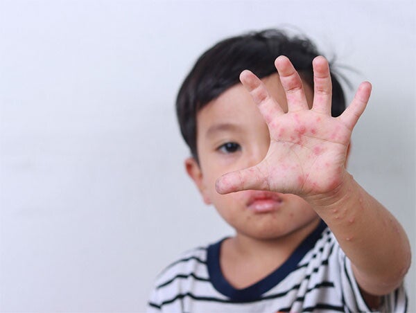 Asian toddler boy shows his palm with rashes, one of the hand, foot, and mouth disease symptoms.