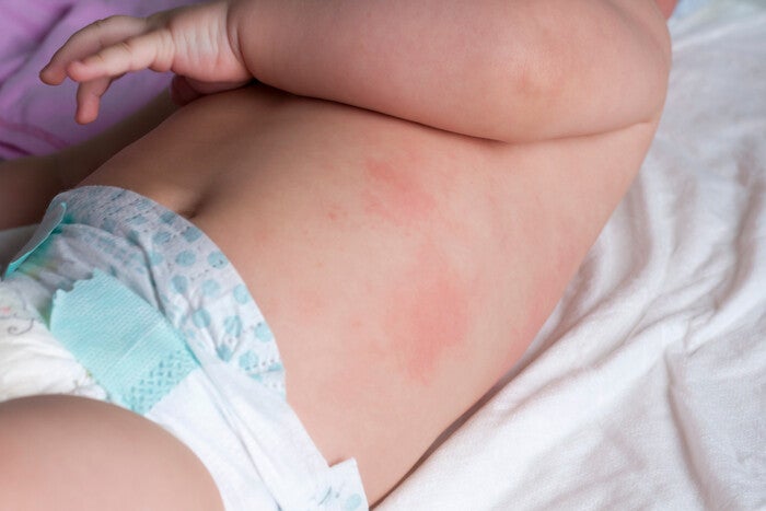 A baby’s torso with bright, red patches on the side.