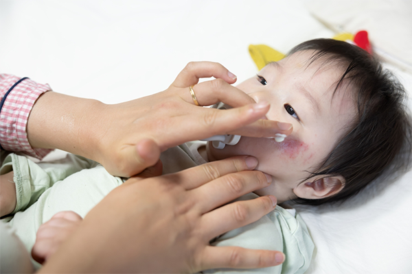 Close-up of mom’s hand applying lotion on newborn’s cheeks to moisturize eczema.