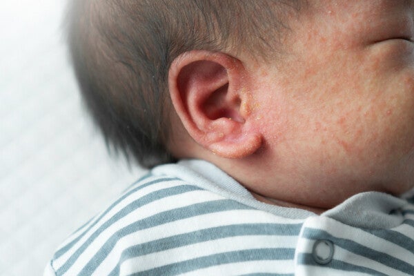 Close-up of the side of a newborn’s ear and cheeks with a facial rash.
