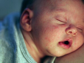 Close-up of a peaceful and sleeping Asian baby with newborn rash on face.