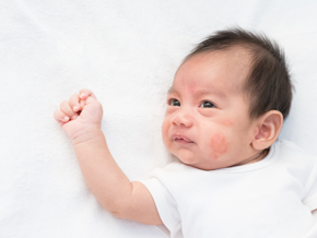 Close-up pic of a newborn’s face with baby eczema on the cheek