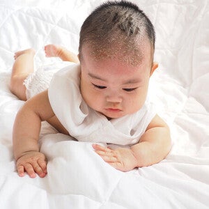 An infant trying to crawl on the bed with baby cradle cap on his scalp.