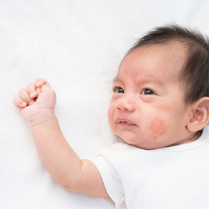 Close-up pic of a newborn’s face with baby eczema on the cheek