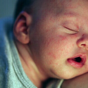 Close-up of a peaceful and sleeping Asian baby with newborn rash on face.