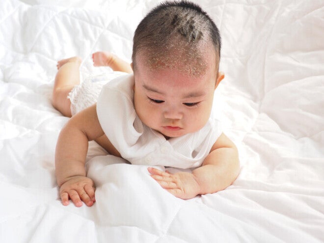 An infant trying to crawl on the bed with baby cradle cap on his scalp.