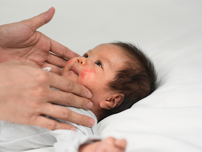 Close-up of mom’s hands checking newborn lying in bed with a baby rash on the cheeks. Close-up of mom’s hands checking newborn lying in bed with a baby rash on the cheeks.