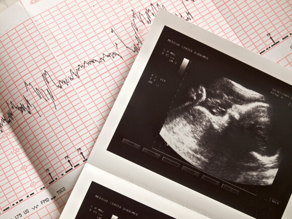 Pregnancy ultrasound portrait of the fetus and cardiogram results.